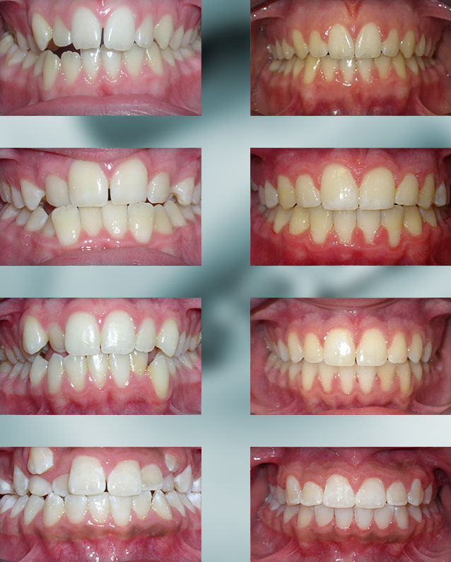 Michael-Riordan-Orthodontics-Before-After-3