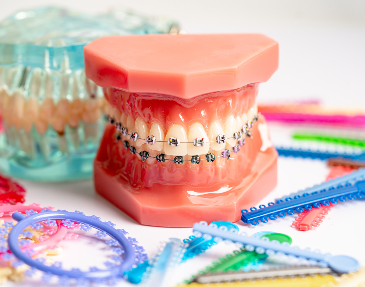 Braces With Colored Bands