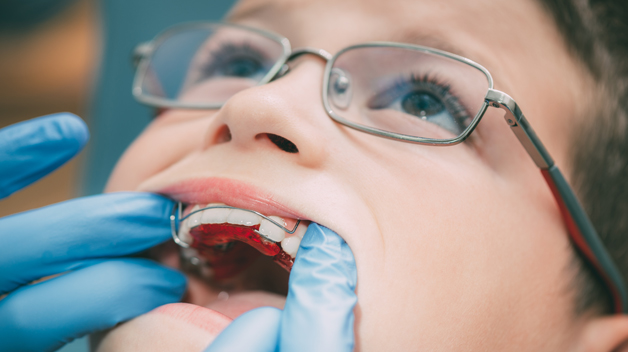 early Orthodontic Treatment